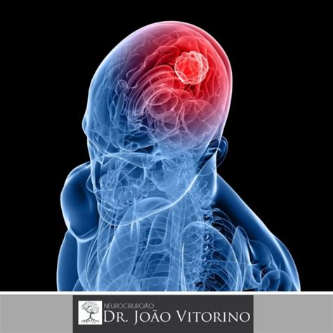 Tumor cerebral   Dr. João Vitorino