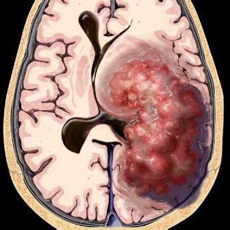 tumor cerebral   Gamma Knife