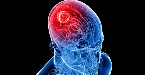 Tumor cerebral maligno o cáncer de cerebro: qué es ...