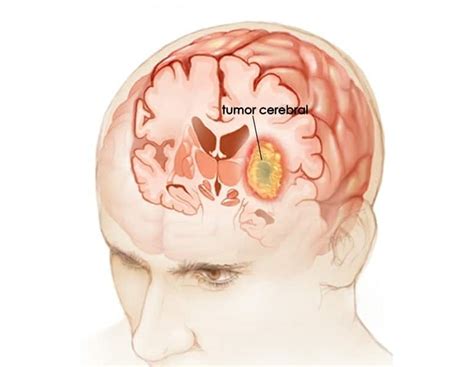 Tumor Cerebral   O que é, Sintomas e Tratamentos! | Dicas ...