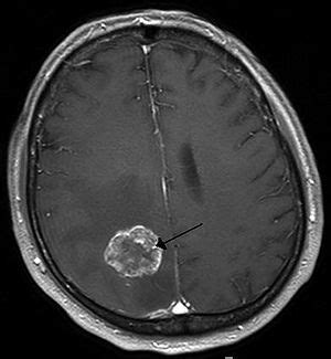 Tumor cerebral – Wikipédia, a enciclopédia livre