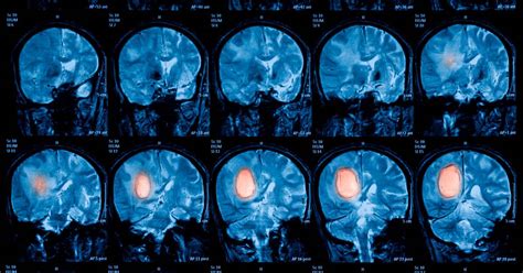 Tumor cerebral   síntomas, causas y tratamientos   Panel ...