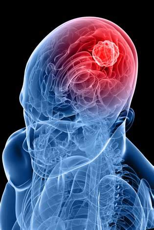 Tumor cerebral: sintomas, tratamentos e causas | Minha Vida