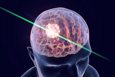 Tumor cerebral: síntomas y signos iniciales
