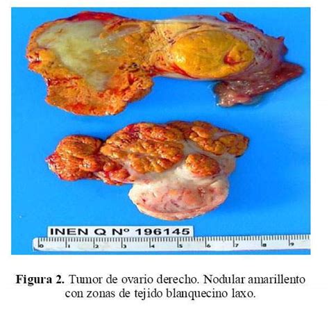 Tumor de células esteroideas de ovario: Reporte de un caso y revisión ...