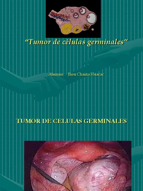 Tumor de Celulas Germinales.ppt | Neoplasias | Cáncer