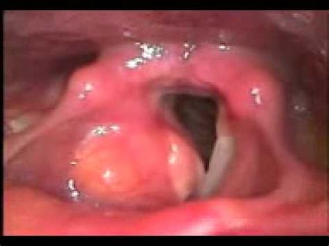 tumor de celulas granulares estagio 3 em mucosa da laringe ...
