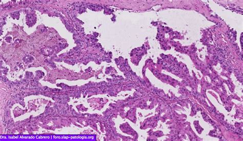 Tumor de glándula mamaria derecha – Sociedad Latinoamericana de Patología