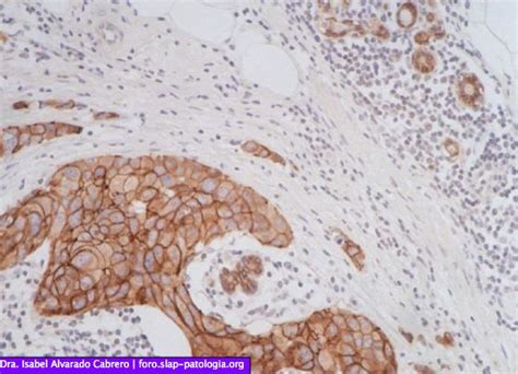 Tumor de glándula mamaria derecha – Sociedad Latinoamericana de Patología