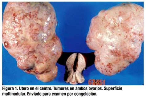 Tumor de Krukenberg del ovario: estudio clínico patológico ...