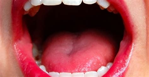 Tumor de la lengua Síntomas y Tratamientos | Salud y Cuidados