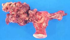 Tumor de ovario   EcuRed