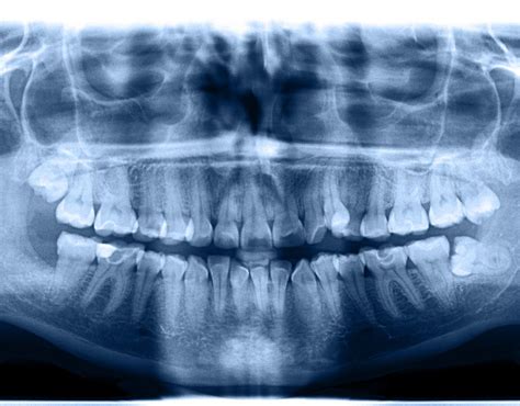 Tumor de parótida; qué es, sintomas, cirugía y postoperatorio   Dr. Samir