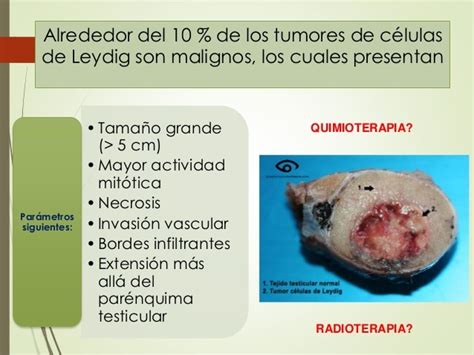 Tumor de Testículo: Células no Germinales