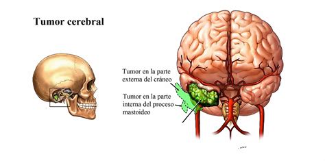 Tumor en el cerebro: Qué es, causas, síntomas y mucho más