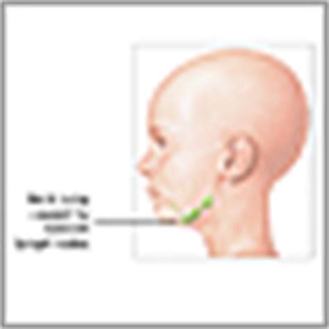 Tumor en el cuello: MedlinePlus enciclopedia médica