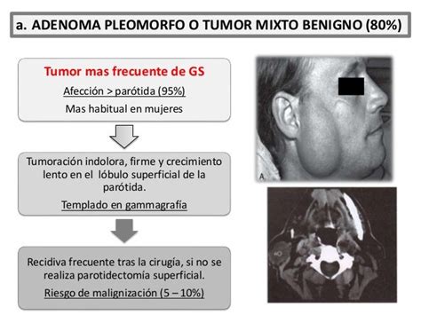 Tumor En La Parotida   SEONegativo.com