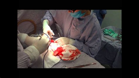 Tumor en niña. Video de cirugía. Teratoma maduro.   YouTube