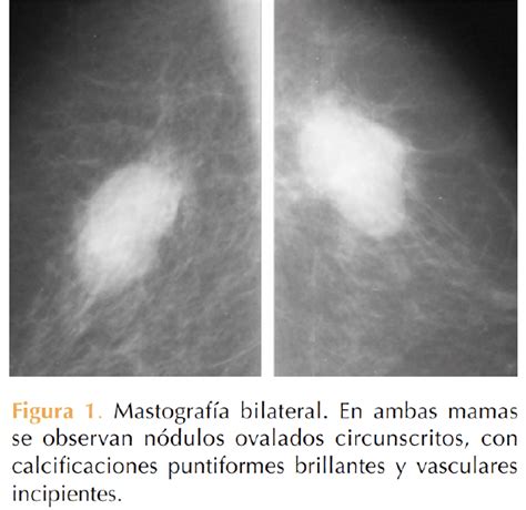 Tumor filodes bilateral, una rara forma de manifestación clínica ...