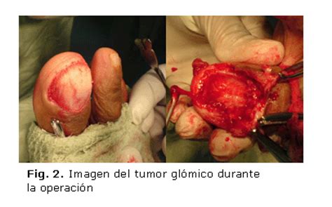 Tumor glómico gigante en un adulto