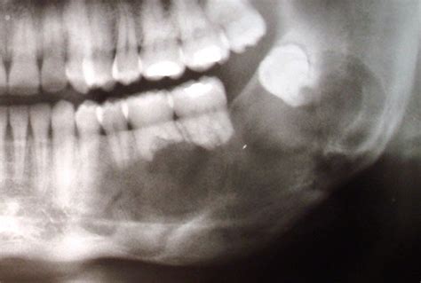 Tumor maxilar: Sintomas y tratamientos | Salud y Cuidados