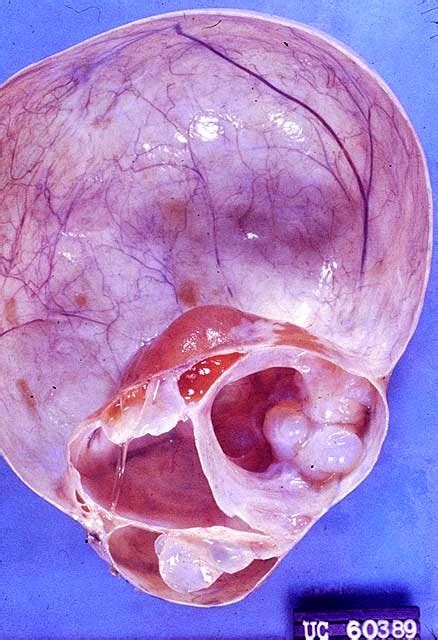 Tumor mucinoso de ovario: Tumor mucinoso de ovario