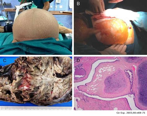 Tumor mucinoso desarrollado en un teratoma ovárico maduro: presentación ...