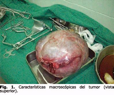 Tumor mucinoso gigante de ovario de bajo grado de malignidad