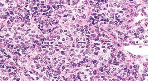 Tumor ovárico maligno de células de la granulosa | FEMEXER