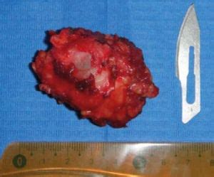 Tumor parótida carcinoma epitelial mioepitelial | Odontologos de Hoy