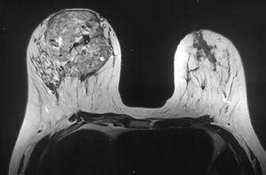 Tumor phyllodes: reporte de un caso tratado con cirugía oncoplástica ...