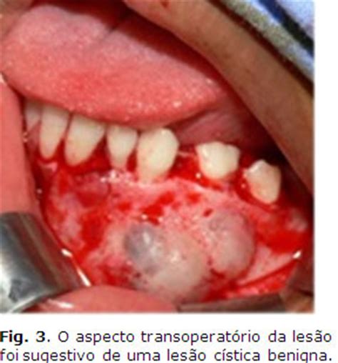 Tumor quístico odontogénico calcificante asociado con ...
