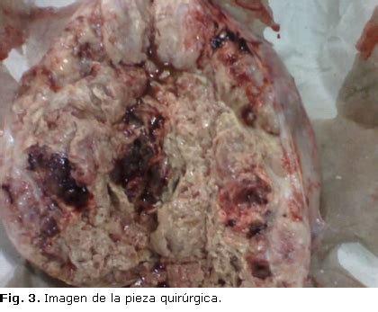 Tumor testicular gigante | Rojas Fiel | Revista Cubana de Urología