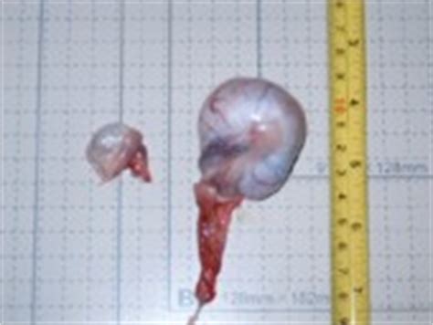 Tumor testicular