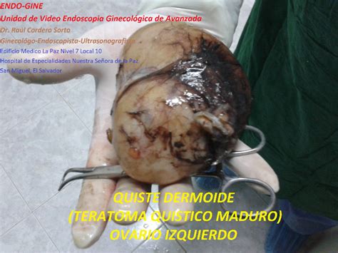 Tumor: Tumor Quistico De Ovario