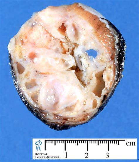 Tumor: Tumor Testicular