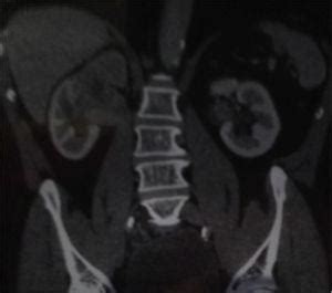 Tumor urotelial renal bilateral y tumor vesical urotelial ...