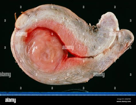 Tumor uterino. Gross espécimen clínico de un útero con un gran ...