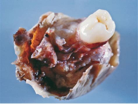 Tumor With Hair And Teeth In Ovary   TeethWalls