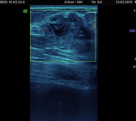 Tumoración mama | Ultrasonido