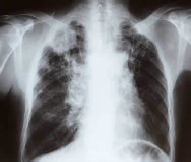 Tumore del polmone: diagnosi precoce non invasiva con il ...