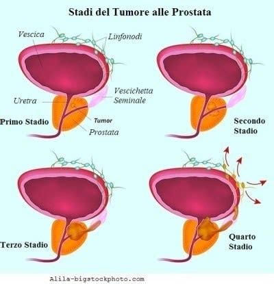 Tumore prostata mortalità