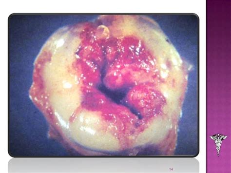 Tumores benignos de cérvix uterino