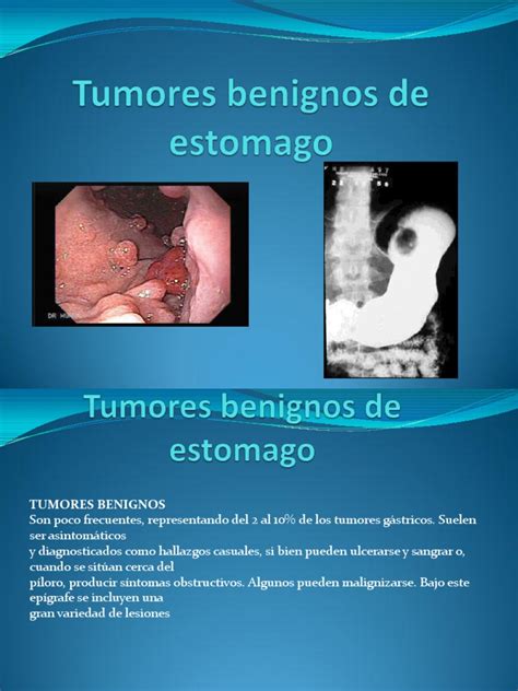 Tumores Benignos de Estomago 29p | Estómago | Cáncer