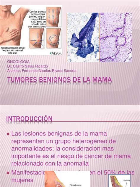 Tumores Benignos de La Mama | Cáncer de mama | Neoplasias