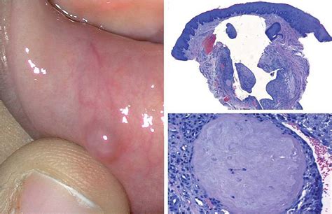 Tumores benignos de la mucosa oral | Piel. Formación continuada en ...