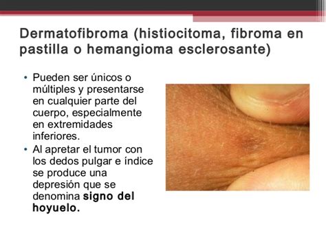 Tumores Benignos de la Piel | UASD