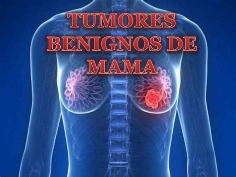 Tumores benignos de mama