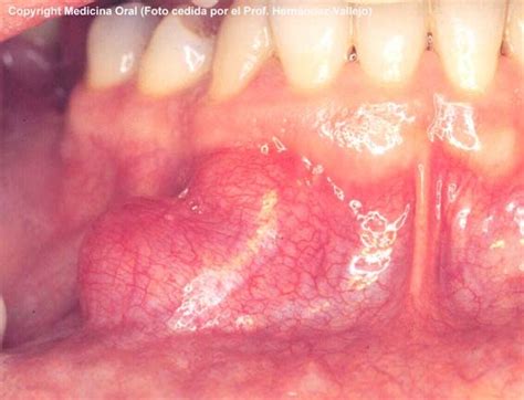 Tumores Benignos de mucosa oral.