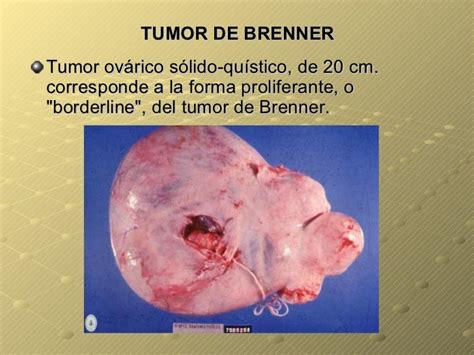 Tumores Benignos De Ovario   SEO POSITIVO